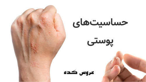 حساسیت‌های پوستی