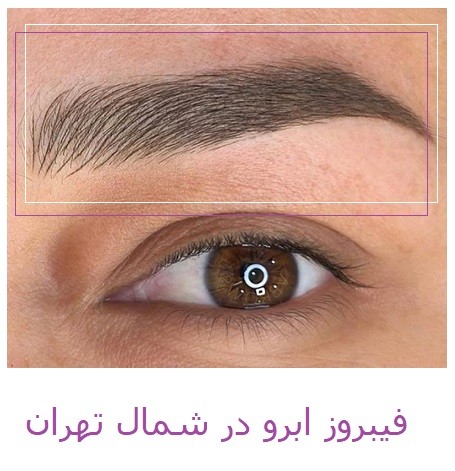 فیبروز ابرو شمال تهران