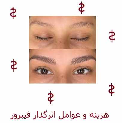 هزینه و عوامل اثرگذار فیبروز